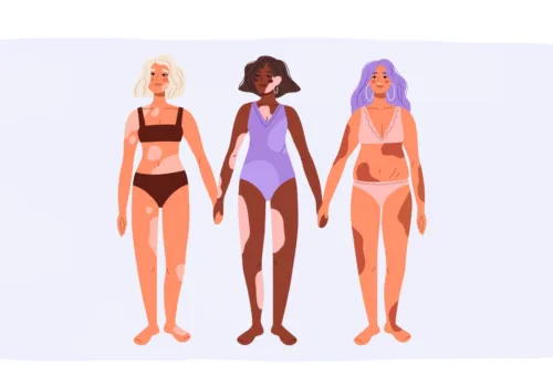 Comment diagnostiquer le vitiligo