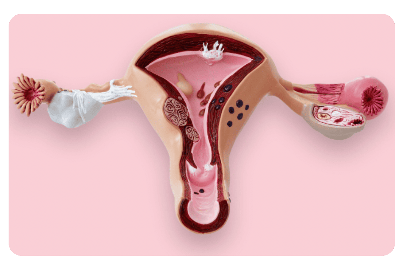 syndrome des ovaires polykystiques